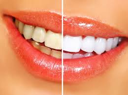 6 Ways to Get White Teeth