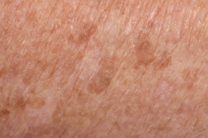 7 Things that Cause Dark Spots and How to Get Rid of Them